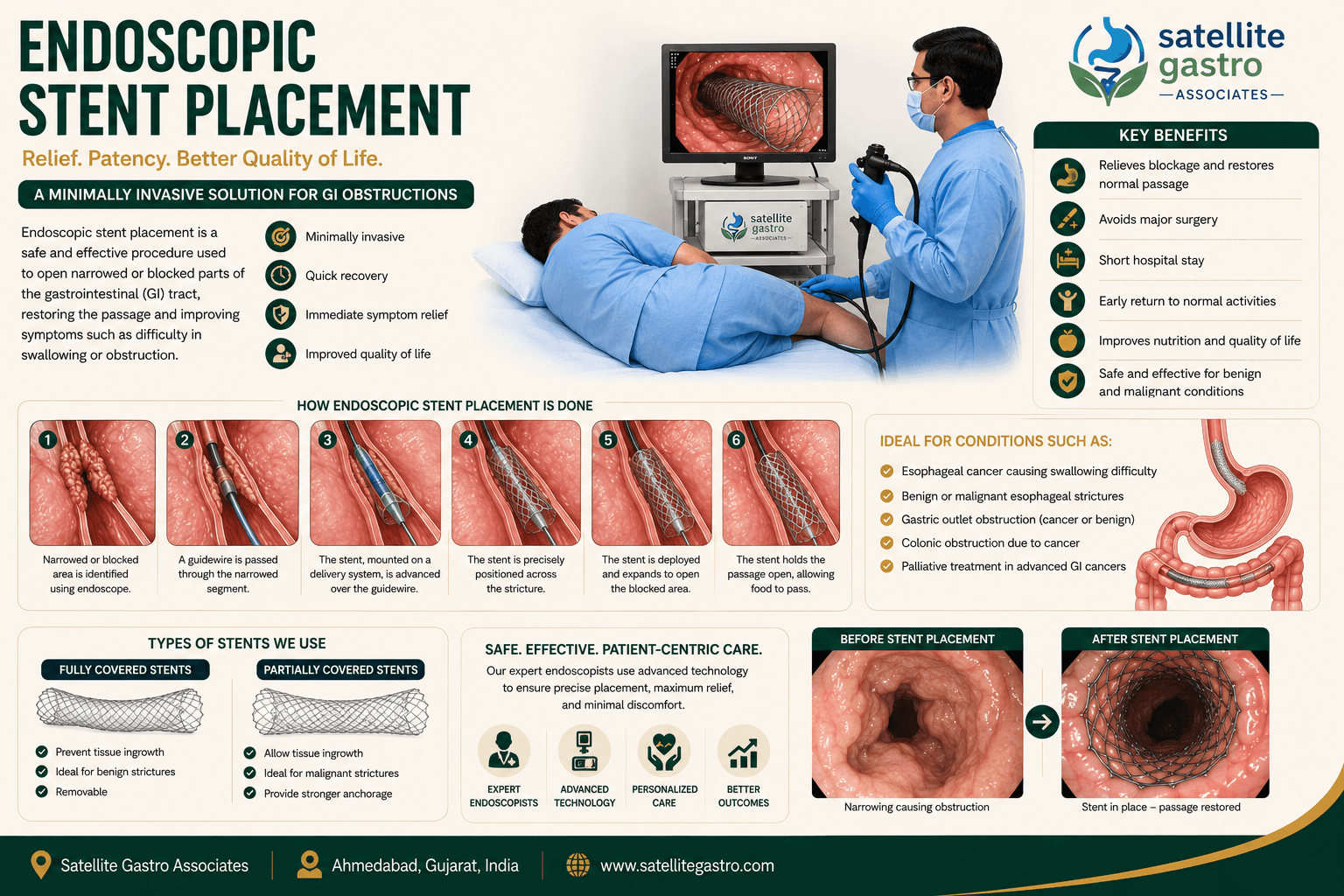 Endoscopic Stent Placement